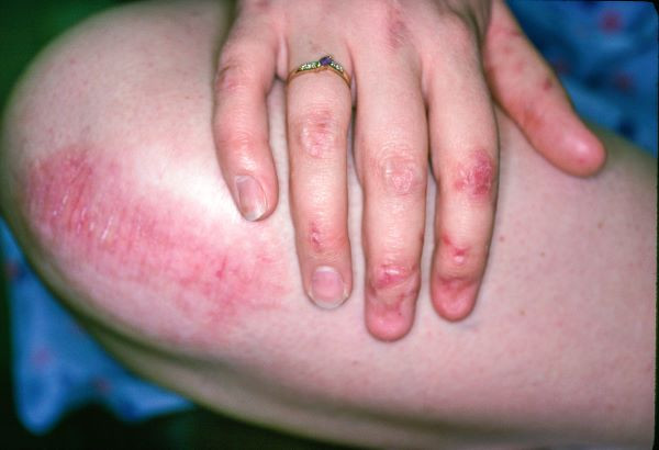 Epidermolisis Bulosa